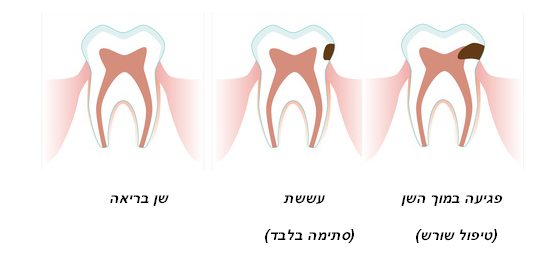 מה זה עששת בשן?