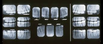 Periapical film